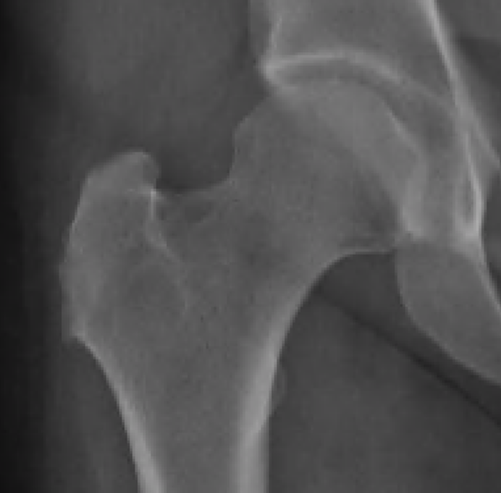 Abductor tendon tears The Bone School